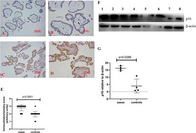 Senescent Changes and Endoplasmic Reticulum Stress May Be Involved in the Pathogenesis of Missed Miscarriage